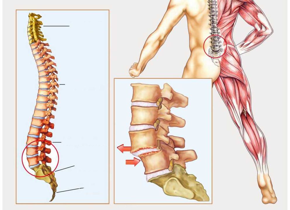 columna vertebral sana e enferma