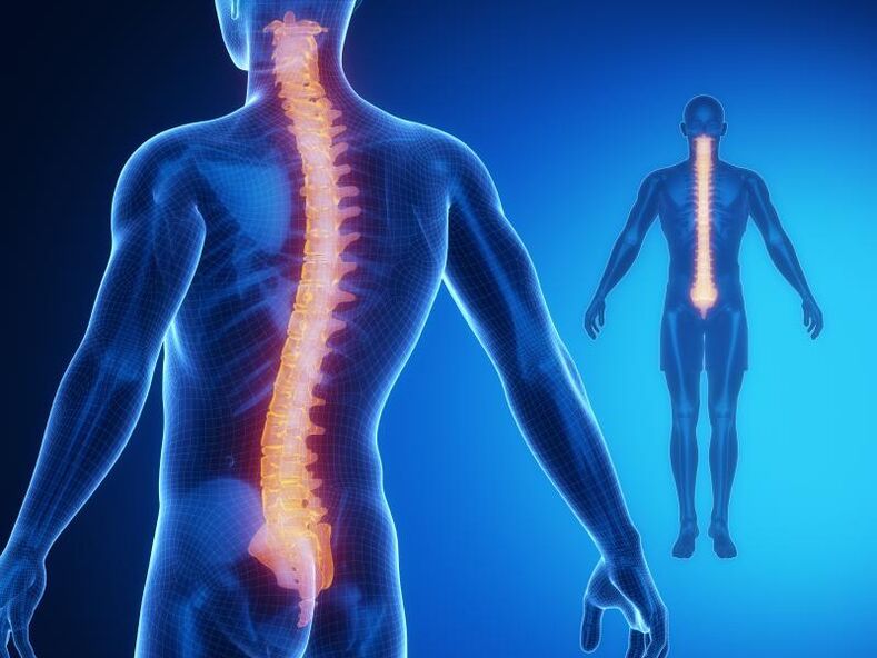 Osteocondrose da columna, que require un tratamento complexo