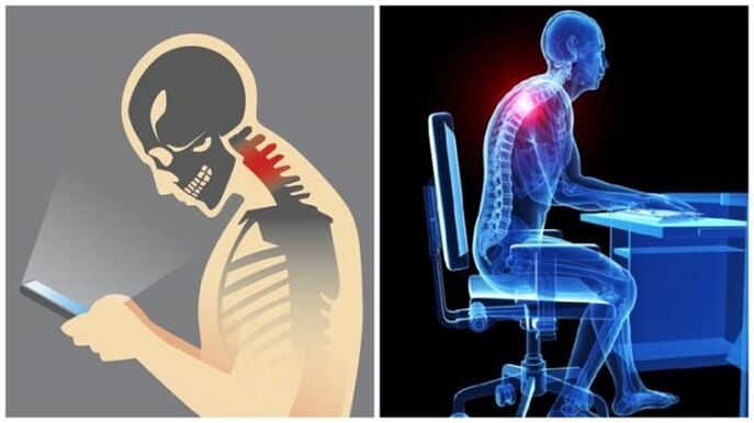 traballo sedentario e inclinación como os motivos para o desenvolvemento da osteocondrose