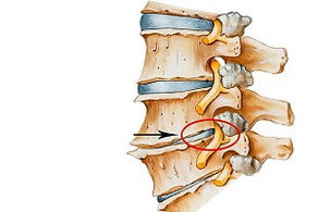 disco pellizcado da columna vertebral como causa de osteocondrose cervical