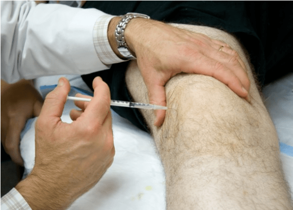 Administración intra -articular de analxésicos con dor severa