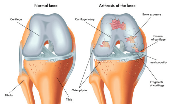 Articulación normal e afectada pola artrose